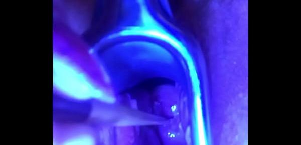  Swollen Ripe Cervix really to be filled with cum is stretched out and sounded